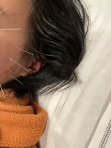 Facial Acupuncture
